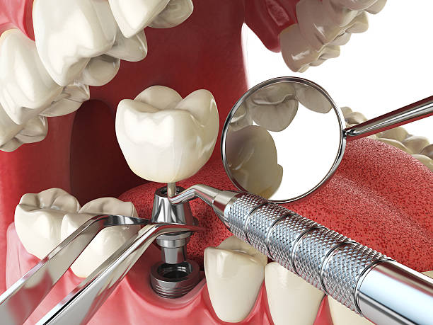Best Emergency Tooth Extraction in Mill Plain, CT