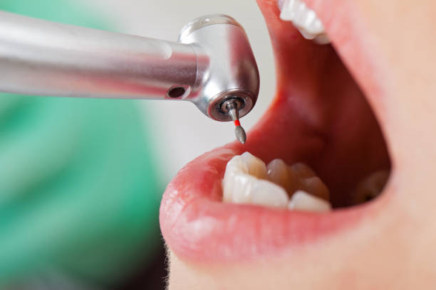 Best Emergency Treatment for Dental Infections or Abscesses in Mill Plain, CT